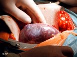 Transplantation einer Niere, Foto: AP