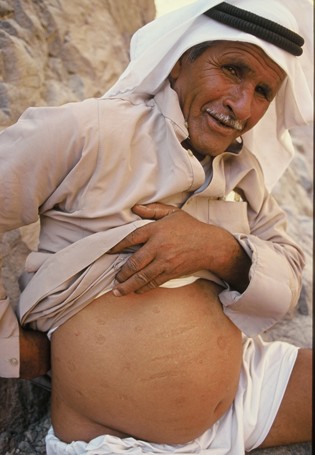 Ein älterer Beduine zeigt auf seine sogenannten "kay bil nar"-Narben