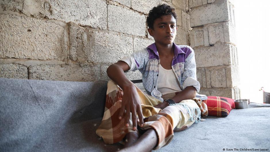صورة معبرة عن معاناة الناس في ظل الحرب في اليمن. Foto:Save the Children/Sami Jassar Dieser Junge ist bei zwei Luftangriffen schwer verletzt worden