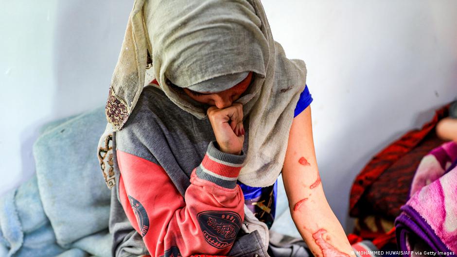 A young women in hospital with severe wounds after an acid attack by her husband (photo: Mohammed Huwais/AFP via Getty Images)